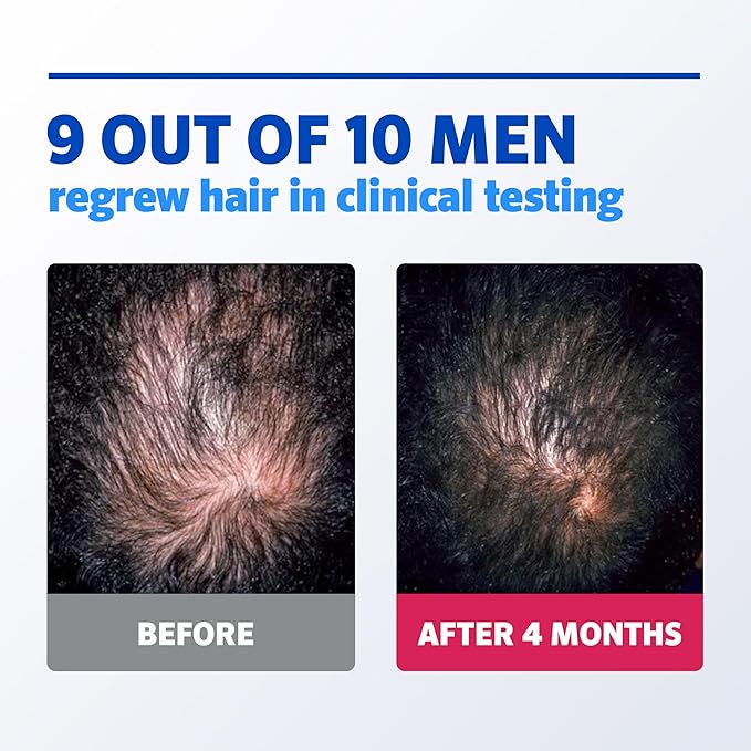 Men’s Rogaine 5% Minoxidil Foam – Hair Regrowth Treatment for Men | 3 x 60g (2.1 oz) Cans – 3 Month Supply